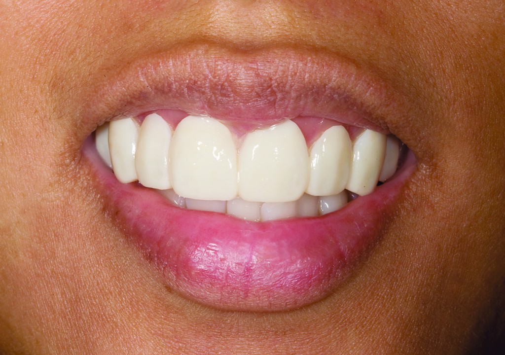 veneers after | Advanced Dentistry of Collegeville