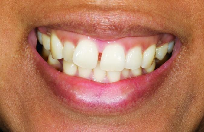 venners before | Advanced Dentistry of Collegeville