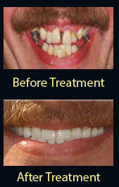dentures collegeville | Advanced Dentistry of Collegeville