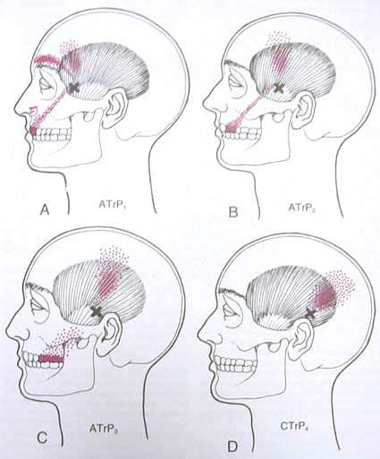 https://collegevilledentistry.com/wp-content/uploads/2016/03/Temporalis.jpg