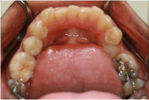 teeth straightening | Advanced Dentistry of Collegeville