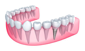 Dental Implants: What They Are & What to Expect | Advanced Dentistry of Collegeville | Collegeville Dentistry | Dr. Nelly