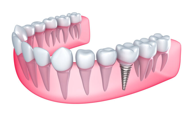 Dental Implants – What They Are and What to Expect Dental Implants: What They Are & What to Expect | Advanced Dentistry of Collegeville | Collegeville Dentistry | Dr. Nelly