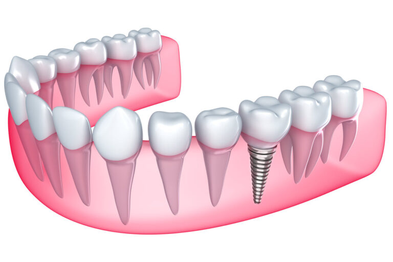 Dental Implants – What They Are and What to Expect Dental Implants: What They Are & What to Expect | Advanced Dentistry of Collegeville | Collegeville Dentistry | Dr. Nelly
