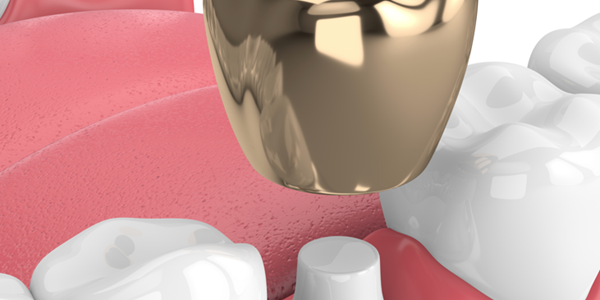 Gold dental crowns may be your best option Gold dental crowns may be your best option