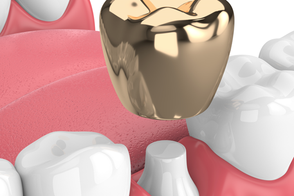 Gold dental crowns may be your best option Gold dental crowns may be your best option