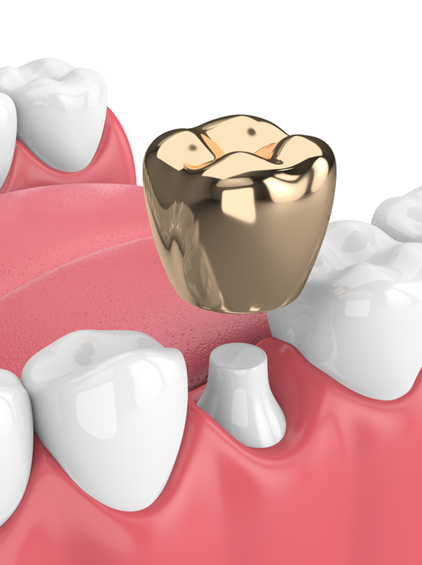 Gold dental crowns may be your best option Gold dental crowns may be your best option