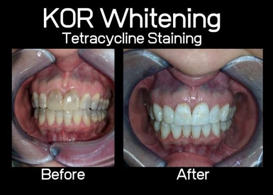 Does kor teeth whitening work