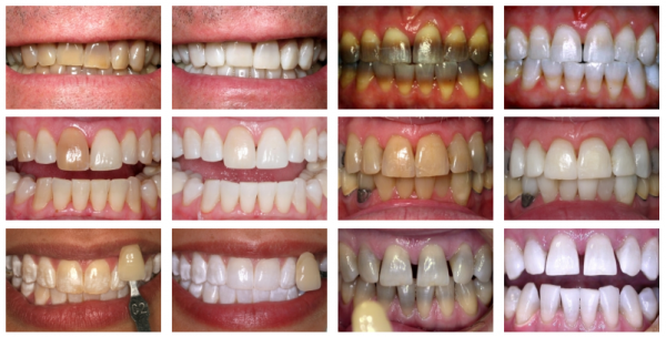 collegeville-k-r-whitening-system-dentist-advanced-dentistry