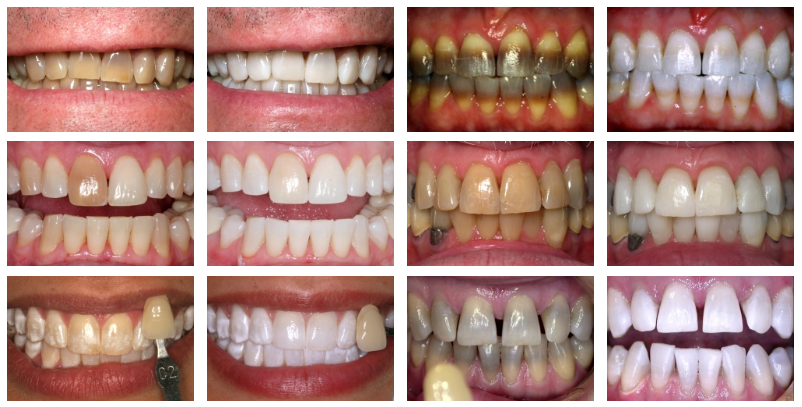 KoR Whitening before and afters | collegeville advanced dentistry