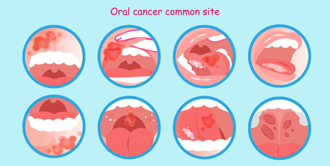 Oral Cancer Facts and Symptoms to Look Out For Oral Cancer Facts and Symptoms to Look Out For | Advanced Dentistry of Collegeville