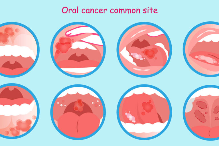 Oral Cancer Facts and Symptoms to Look Out For Oral Cancer Facts and Symptoms to Look Out For | Advanced Dentistry of Collegeville
