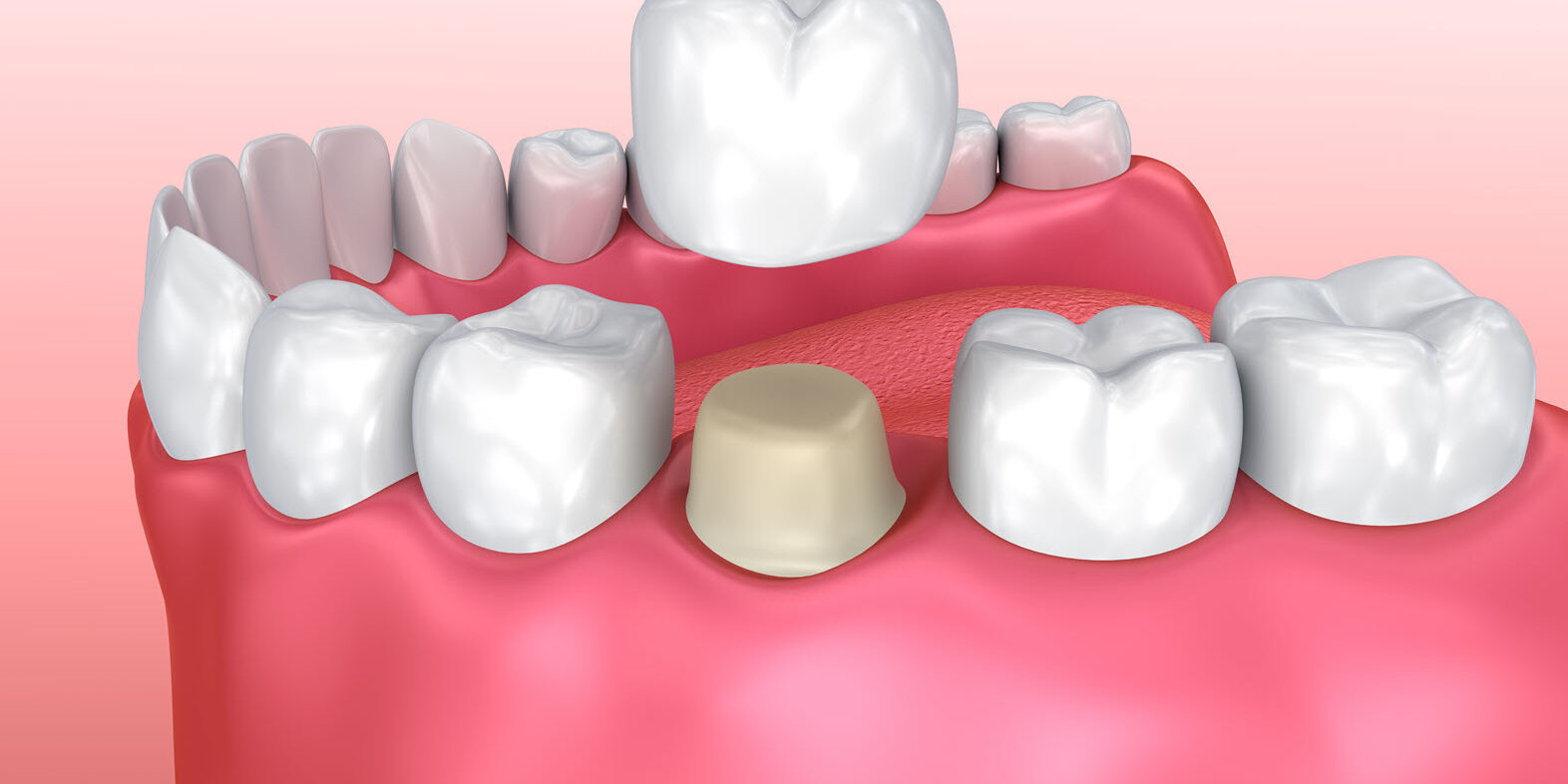 Weighing the Pros and Cons of Dental Crowns Weighing the Pros and Cons of Dental Crowns | Advanced Dentistry of Collegeville