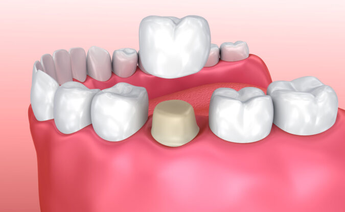 Weighing the Pros and Cons of Dental Crowns Weighing the Pros and Cons of Dental Crowns | Advanced Dentistry of Collegeville