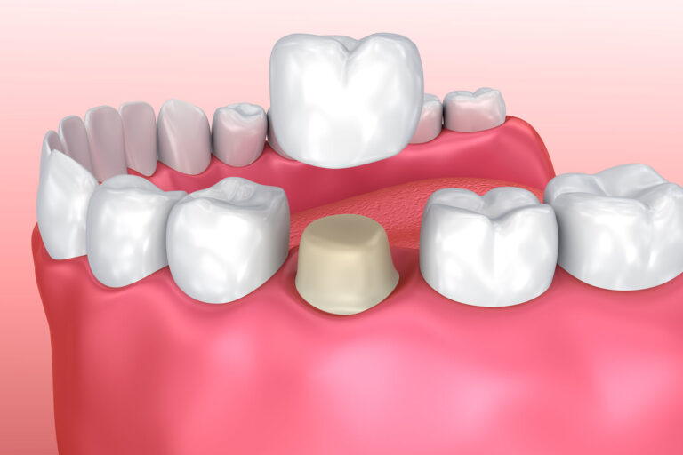 Weighing the Pros and Cons of Dental Crowns Weighing the Pros and Cons of Dental Crowns | Advanced Dentistry of Collegeville