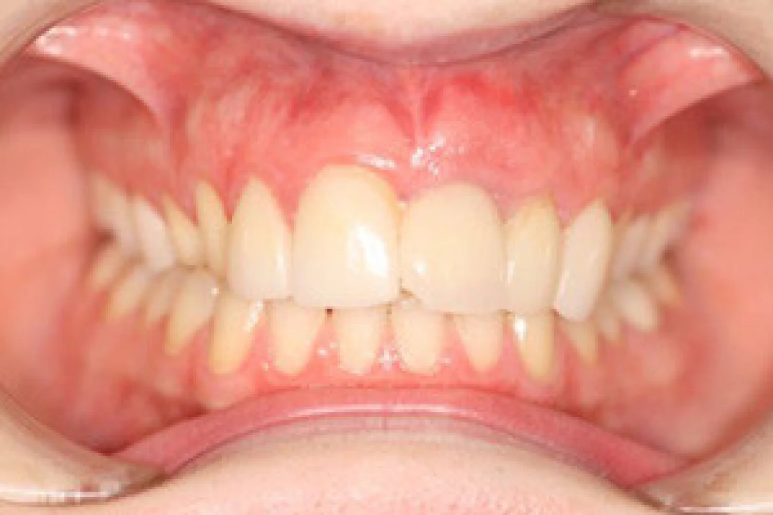 Before treatment
