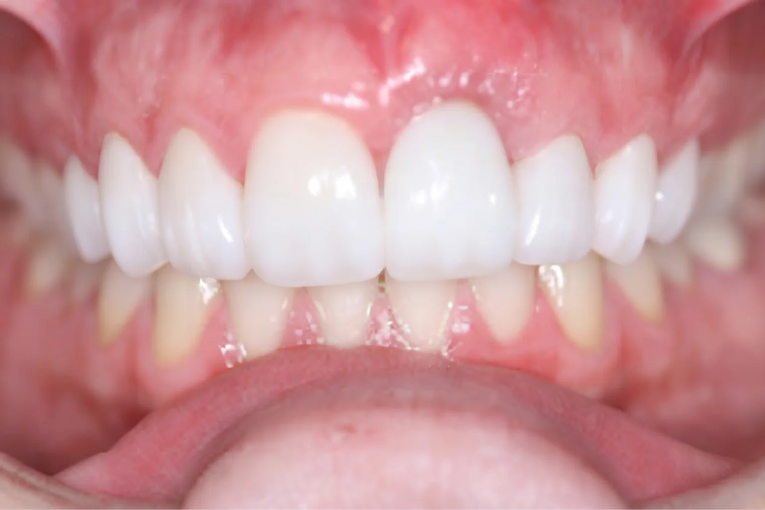 After treatment