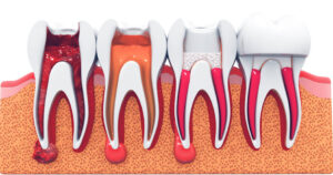 Root Canals: The Unfiltered Truth | Advanced Dentistry of Collegeville