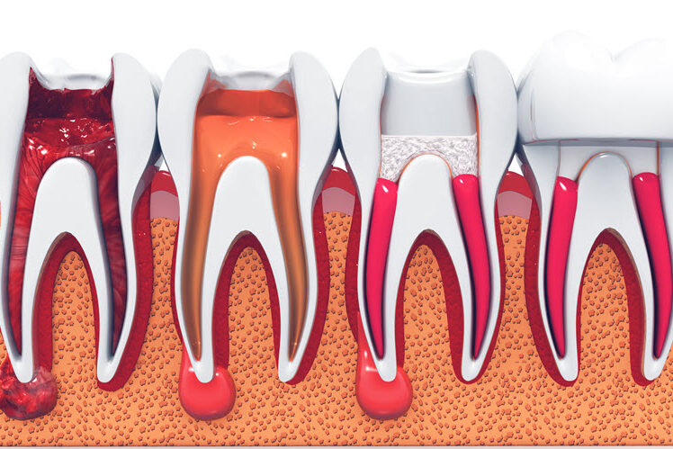 root canals – the unfiltered truth Root Canals: The Unfiltered Truth | Advanced Dentistry of Collegeville